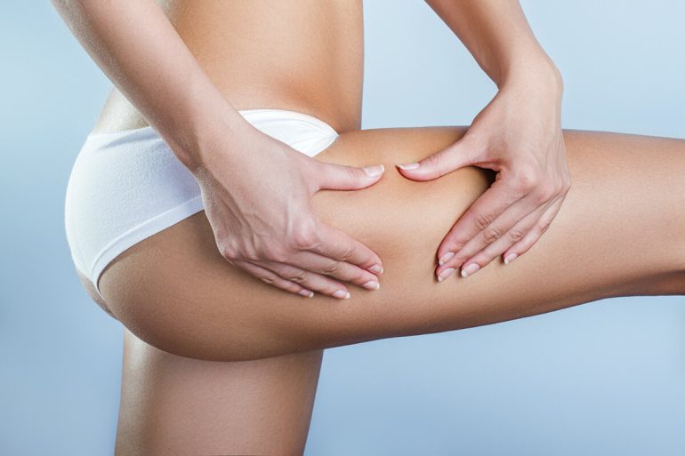 Cellulite, cosa fare per ridurla?