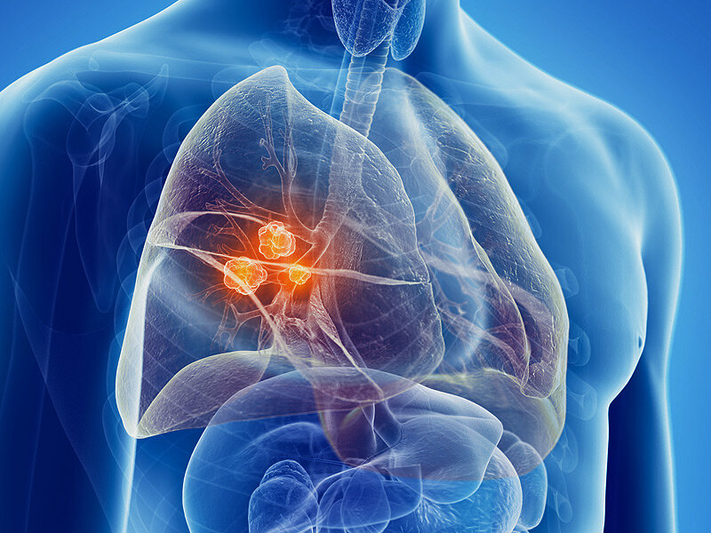 Ricercatori dell’Università di Salerno scoprono un biomarcatore del cancro polmonare