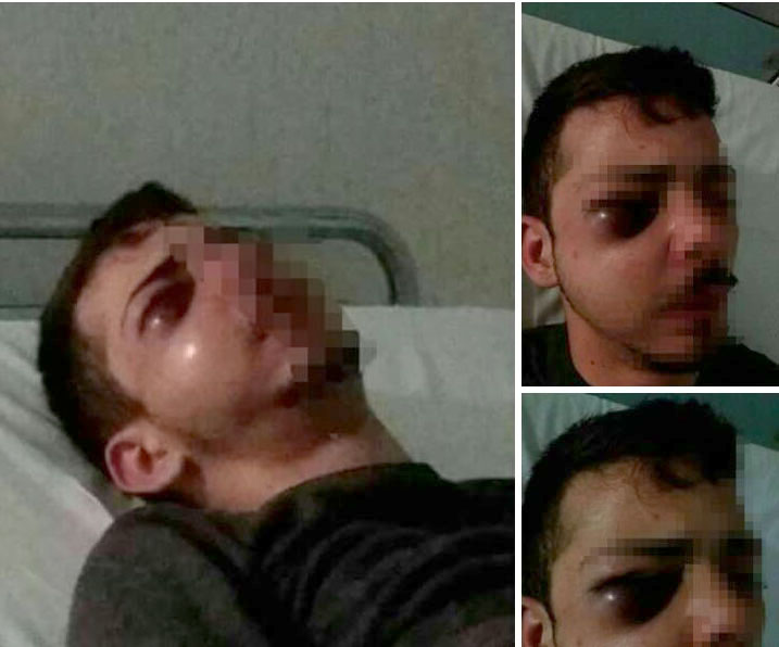 Aggressori seriali nelle stazioni Circum, giovane di Ercolano picchiato finisce in ospedale: l’appello su Fb per trovare i colpevoli