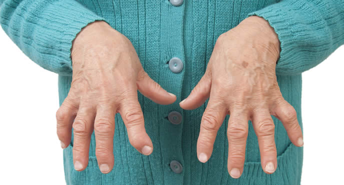 Artrite reumatoide: la scoperta, metà italiana