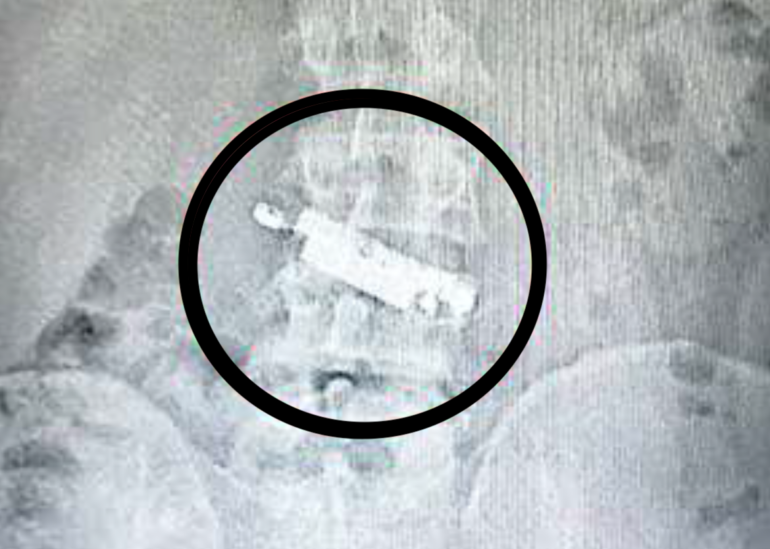 Napoli. Detenuto nasconde il cellulare nella pancia per un mese