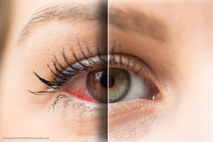 Oculistica, l’allarme dello specialista: “In aumento i casi di “Dry Eye” per chi passa ore davanti a smartphone e pc”