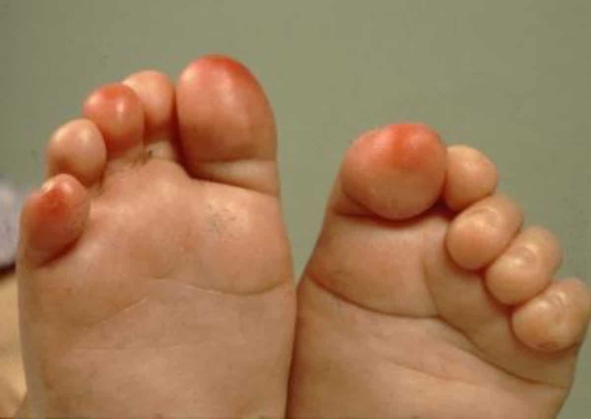 lesioni sulle dita dei piedi