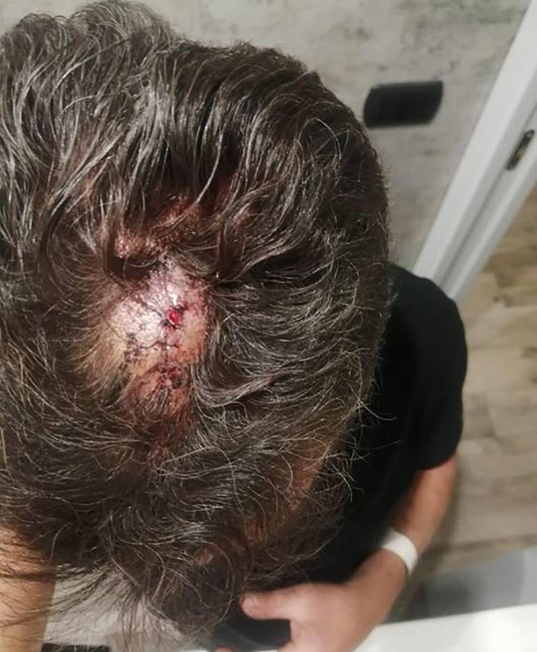 Napoli, dipendente Anm aggredito nella stazione della metro