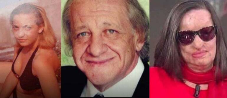 Napoli, il marito la deturpò con l’acido, ora a Filomena Lamberti è stata restituita la sensibilità sulla pelle