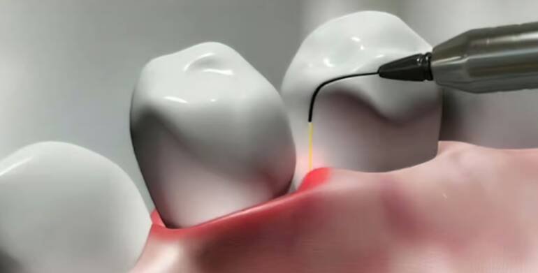 Malattie infiammatorie: come riconoscere la parodontite?