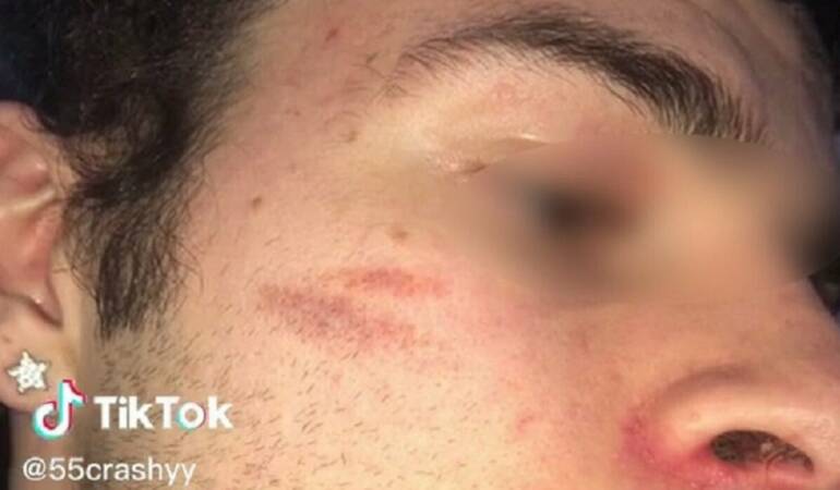 La folle sfida della “cicatrice francese” spopola sul web, Antitrust avvia istruttoria contro TikTok