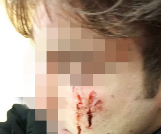 Movida violenta a Napoli. La denuncia di una mamma ‘Mio figlio 16enne pestato a sangue, naso e denti spaccati’