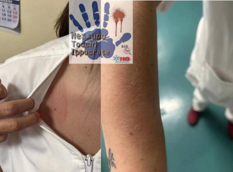 Acerra, donna con covid picchia infermiera dopo esse stata scoperta