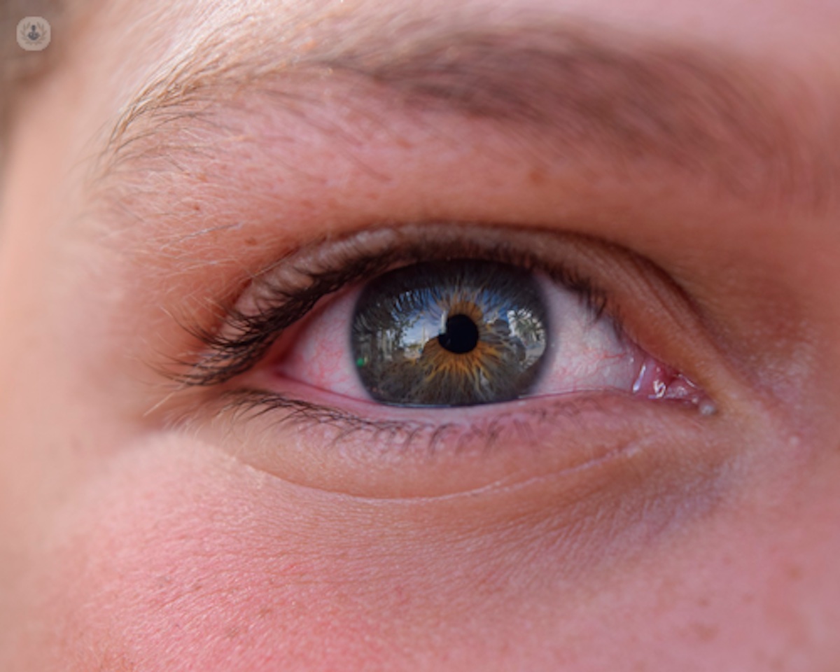 Giornata mondiale delle malattie rare. Aimo: oltre 900 quelle oculari, cheratocono la più diffusa