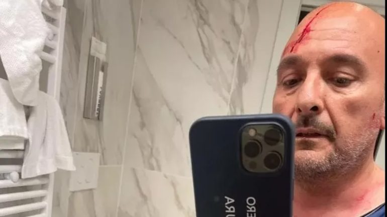 Lite Sangiuliano-Boccia: la nuova foto dell'ex ministro ferito