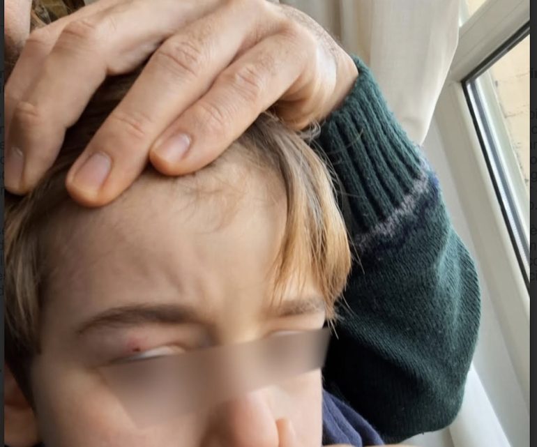 Napoli, bambino travolto da scooter sul marciapiede al corso Secondigliano
