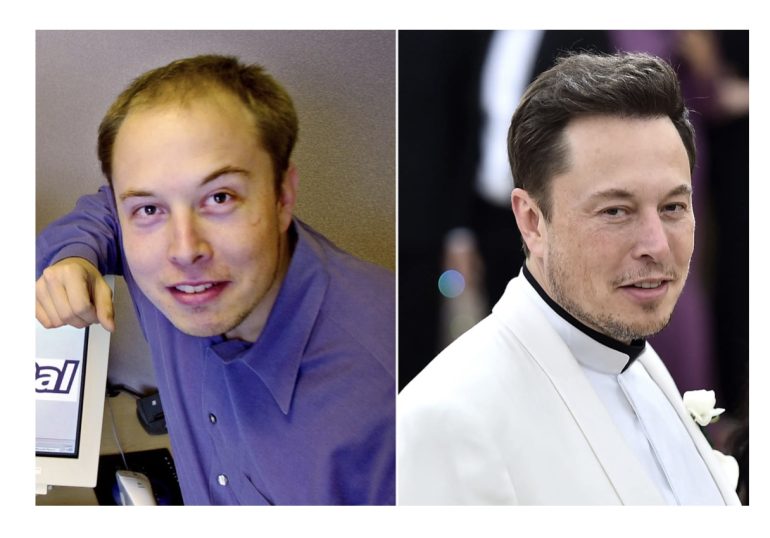 Le celebrità che hanno fatto il trapianto di capelli e perché alcune hanno scelto la turchia