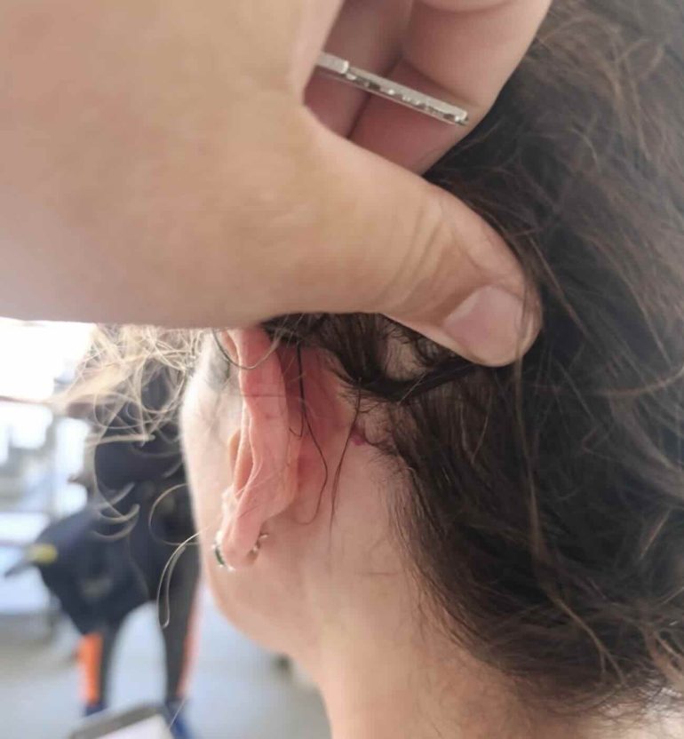 Napoli, donna ferita alla testa con un colpo di pistola ad aria compressa