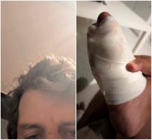 Giornalista aggredito a Mappatella Beach mentre denuncia gli abusivi: tentato strangolamento in diretta