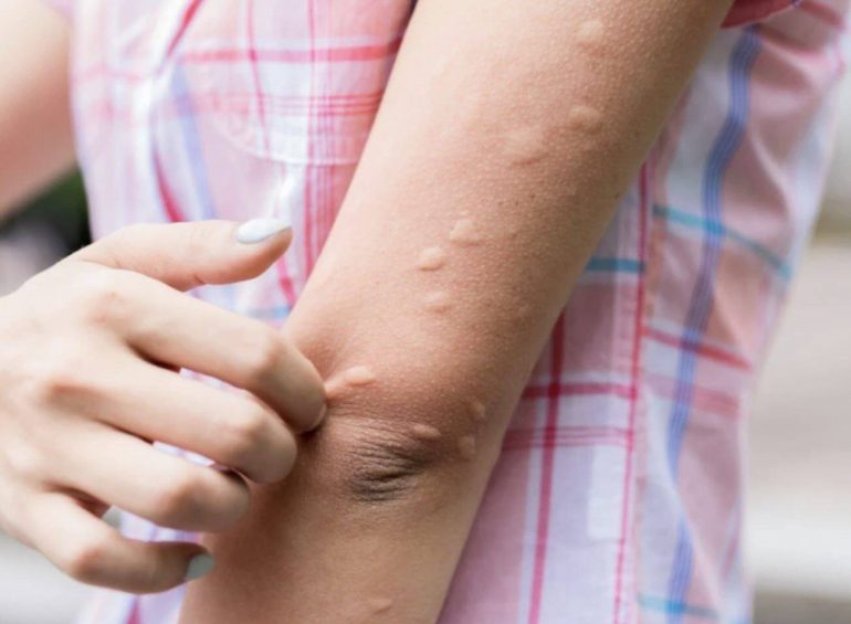 West Nile, quinta vittima in Campania: cresce l’allarme tra la popolazione