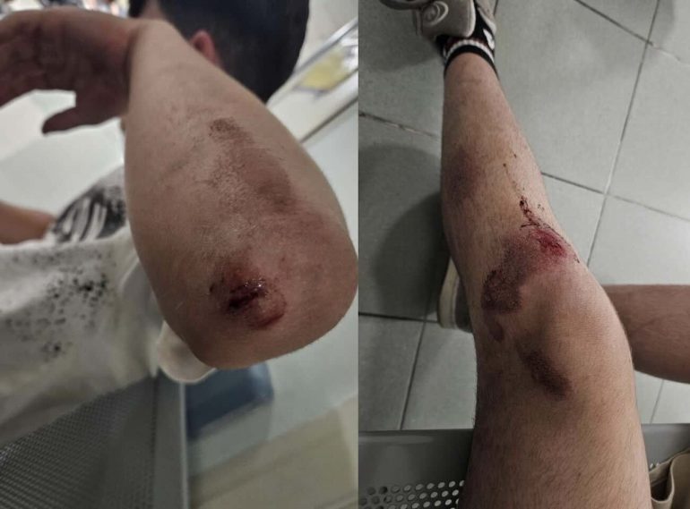 Poggiomarino, la violenza giovanile non si ferma: 14enne aggredito dal branco per una caduta in bici