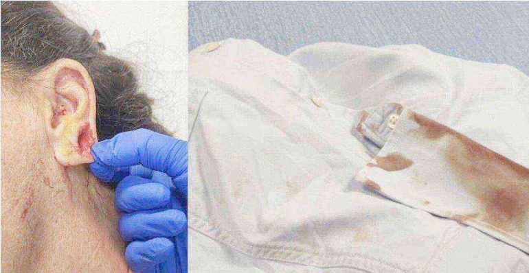 Napoli, controllara Anm ferita da un passeggero senza biglietto