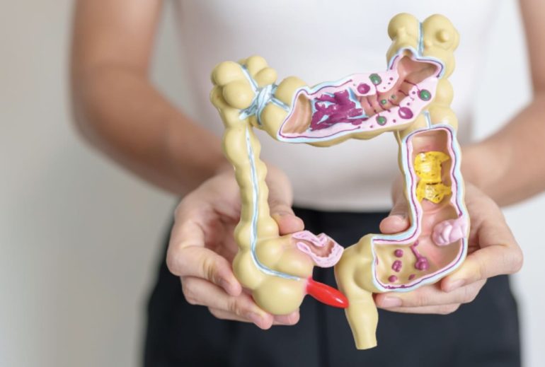 Tumori del colon e salute orale: il nuovo legame tra microbioma e rischio oncologico