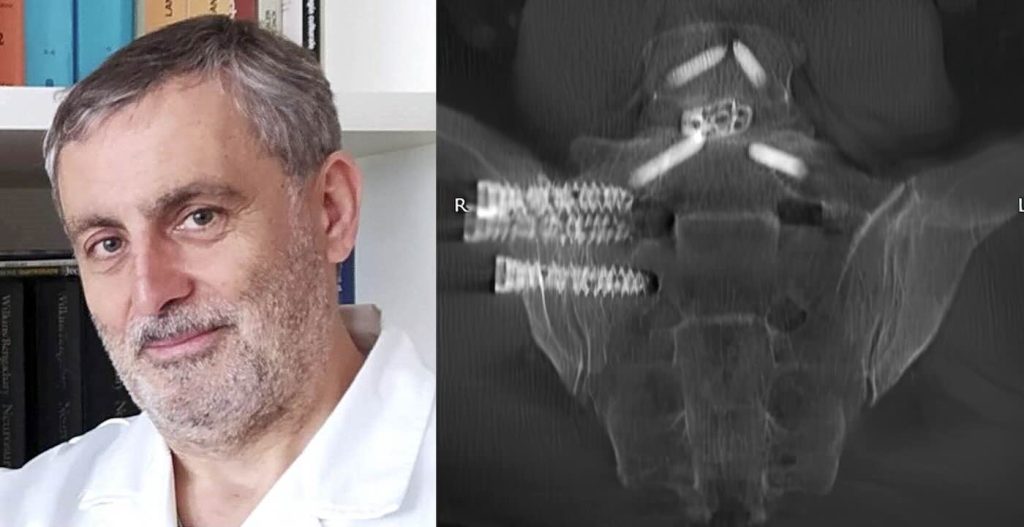 Villa dei Fiori, artrodesi sacroiliaca di ultima generazione