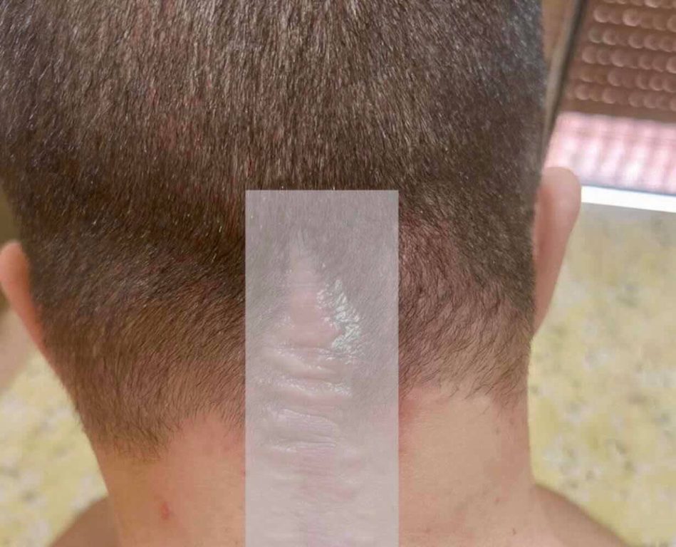 Pomigliano, prigioniero in casa da 4 anni: “Mio figlio disabile bloccato al terzo piano senza ascensore”