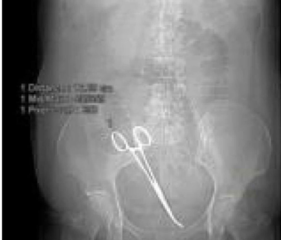 Napoli, chirurgo dimentica pinze nella pancia: donna scopre l’orrore dopo 5 mesi