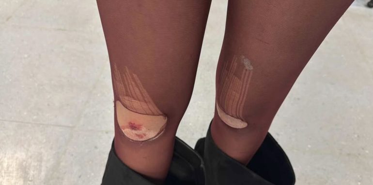 Marigliano, follia in Villa Comunale: 15enne aggredita e ferita dalle coetanee