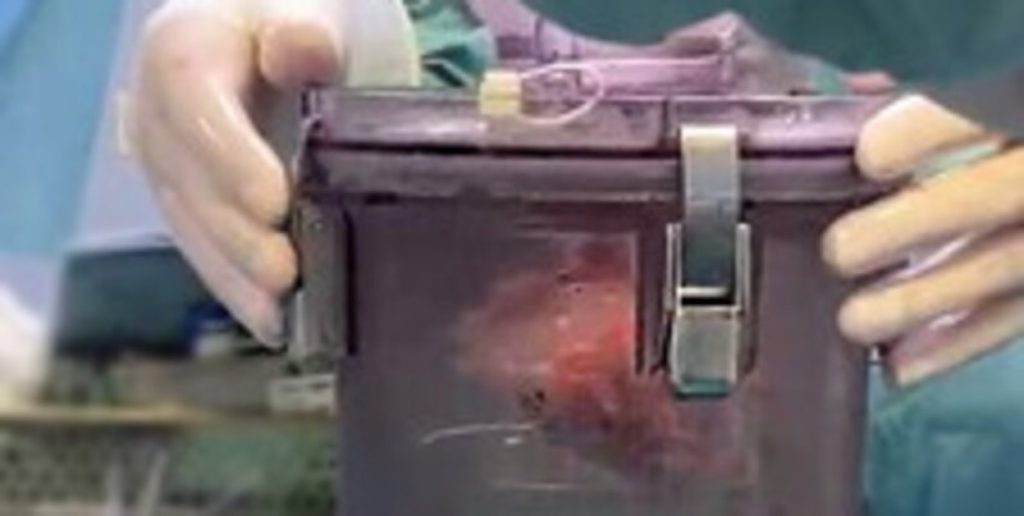 Napoli, cuore trapiantato a bimbo di due anni: sequestrato il box di trasporto dell’organo