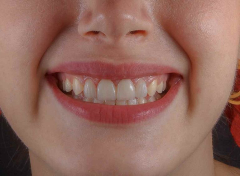 Quando scegliere un impianto dentale dopo la perdita di un dente