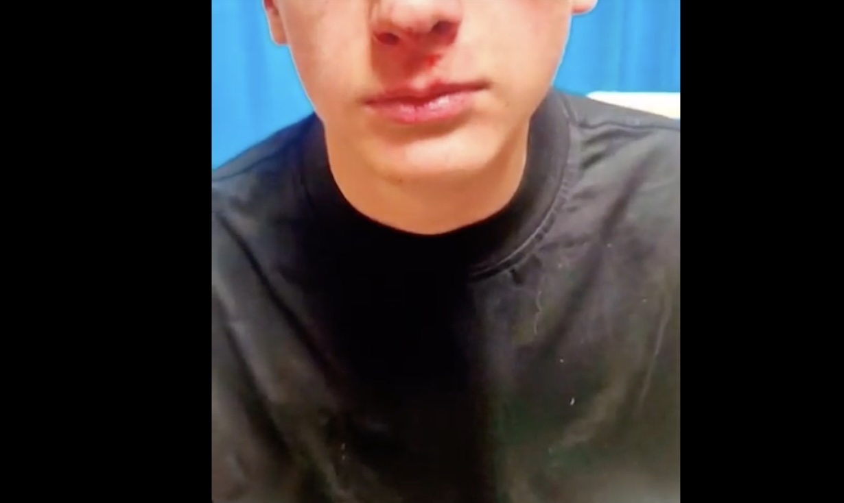 Terribile aggressione a Fuorigrotta: ragazzo di 15 anni picchiato in pieno giorno prima di Pasqua