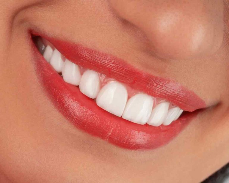 Impianto dentale totale: la soluzione definitiva per chi porta la protesi mobile