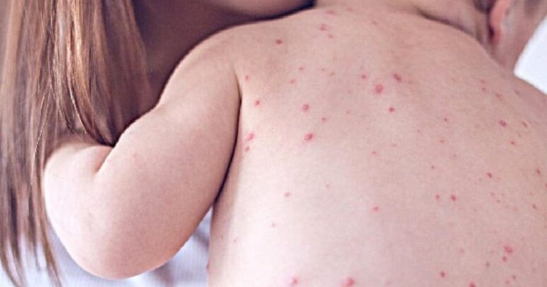 Morbillo, impennata di casi in Italia: quasi 500 contagi nei primi mesi del 2026. Boom in Calabria